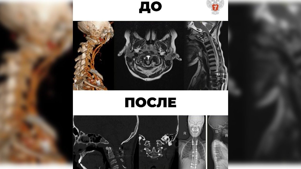 Специалисты федерального центра Минздрава России вернули способность ходить парализованному подростку из Перми