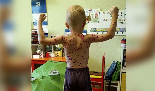 Не шутите с ветрянкой. От чего можно спастись, поставив прививку